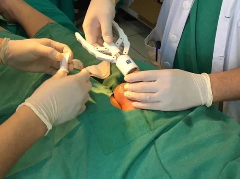 Phẫu thuật cắt bao quy đầu là phương pháp điều trị an toàn, hiệu quả cao